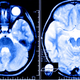 Illustration for article titled Brain Pacemakers Are Starting To Be Used To Fight Alzheimers Disease